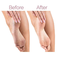 Rechargeable Electric Foot Callus Remover – Pedicure