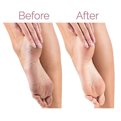 Electric Foot File Callus Remover | Rechargeable
